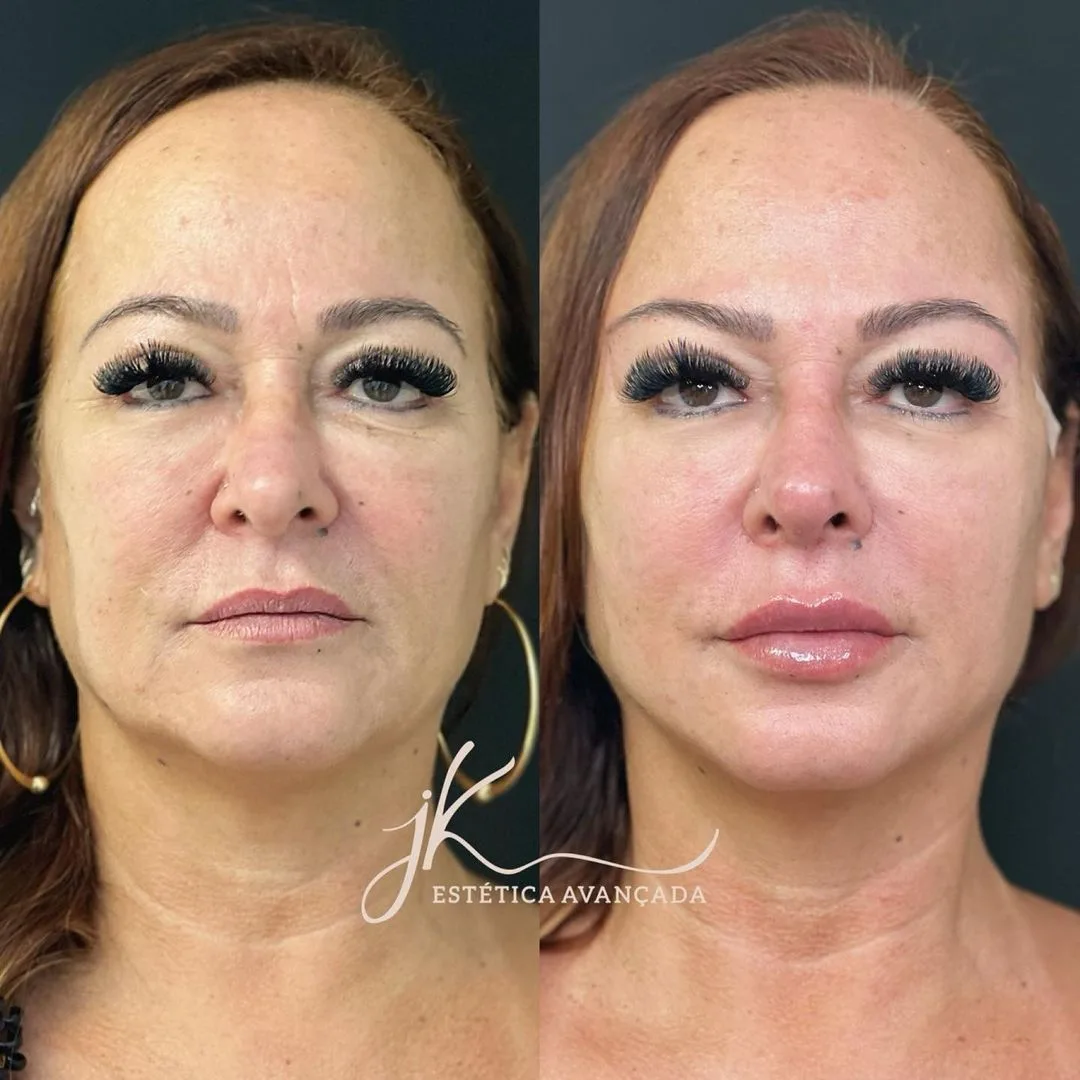 Antes e depois! Mãe de Neymar faz harmonização facial e surge novinha