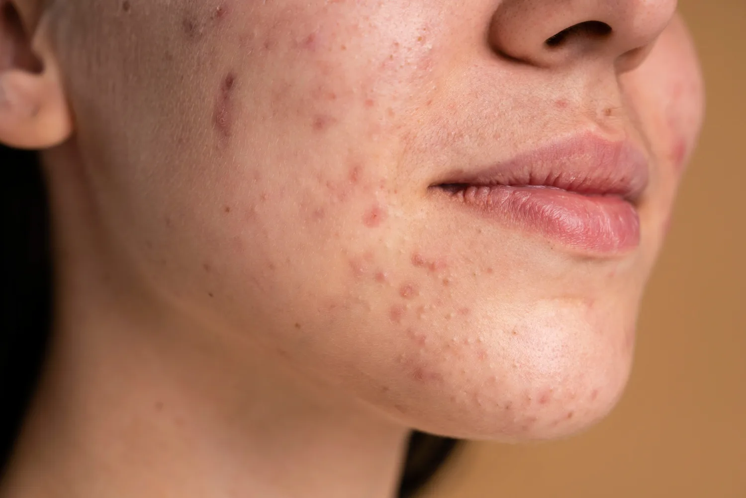 Acne atinge 80% jovens; saiba como tratar o problema