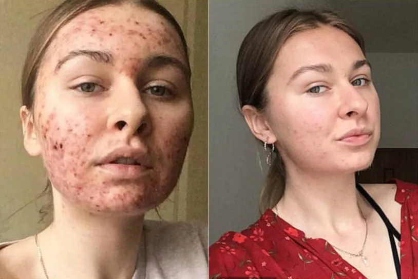 Jovem revela como dieta resolveu problema com acne