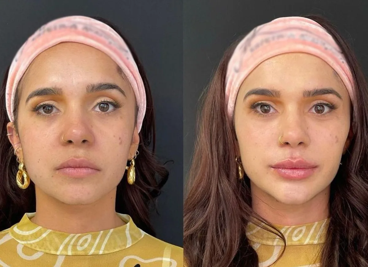 Ex-BBB capixaba Gizelly faz harmonização facial. Veja antes e depois!