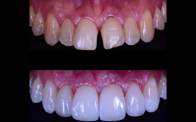 Lentes de contato dental podem ser aplicadas em restaurações