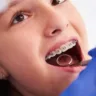 aparelho-crianca-dentes