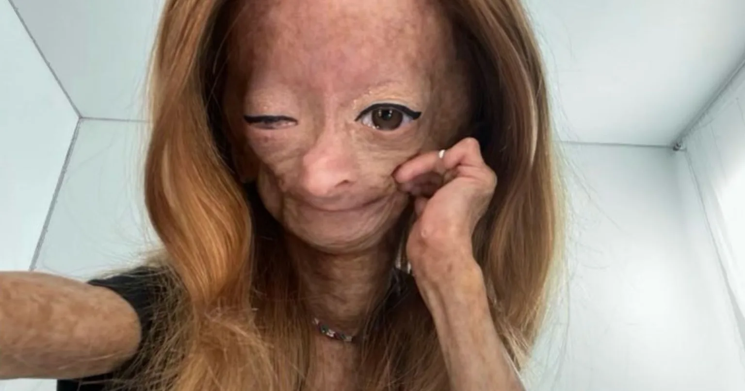 Morre Adalia Rose, youtuber com doença de Benjamin Button, aos 15 anos