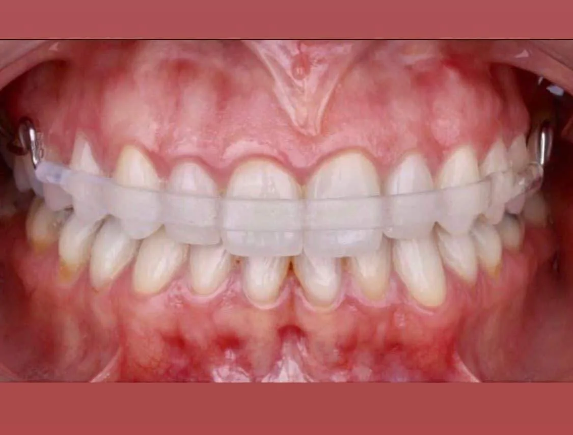 Qual a melhor contenção para os seus dentes?