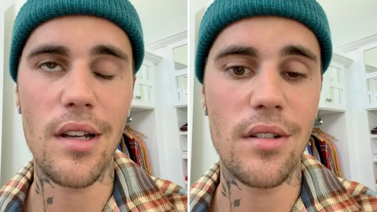 Síndrome de Ramsay Hunt: entenda condição que paralisou parte do rosto de Justin Bieber