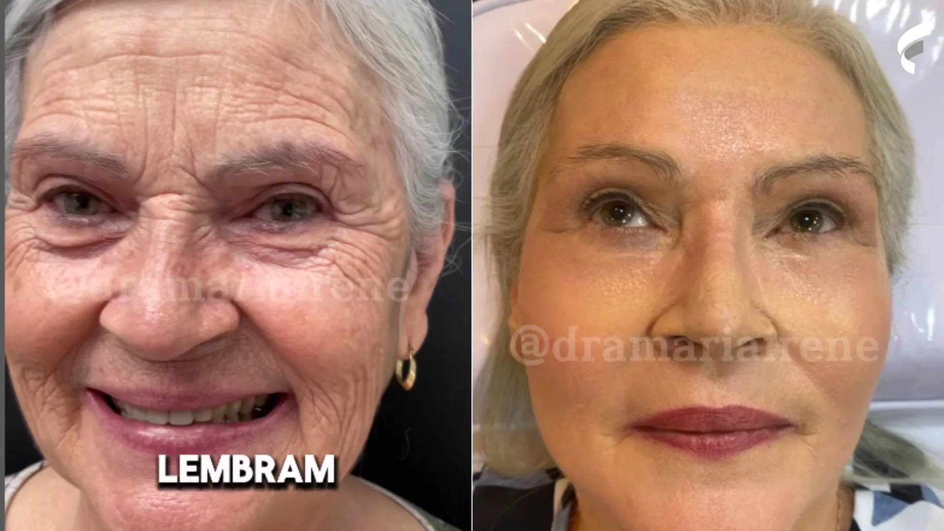 Antes e depois! Mulher vende carro para fazer procedimento estético: “Rejuvenesceu”