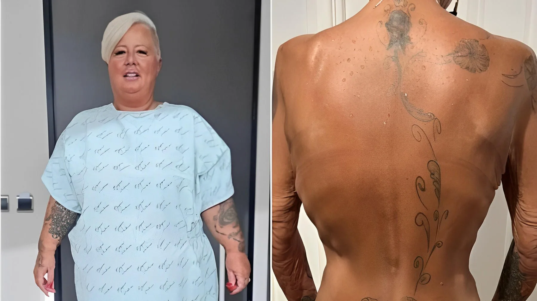 Mulher faz cirurgia bariátrica, perde 60kg e não para de emagrecer. Entenda caso