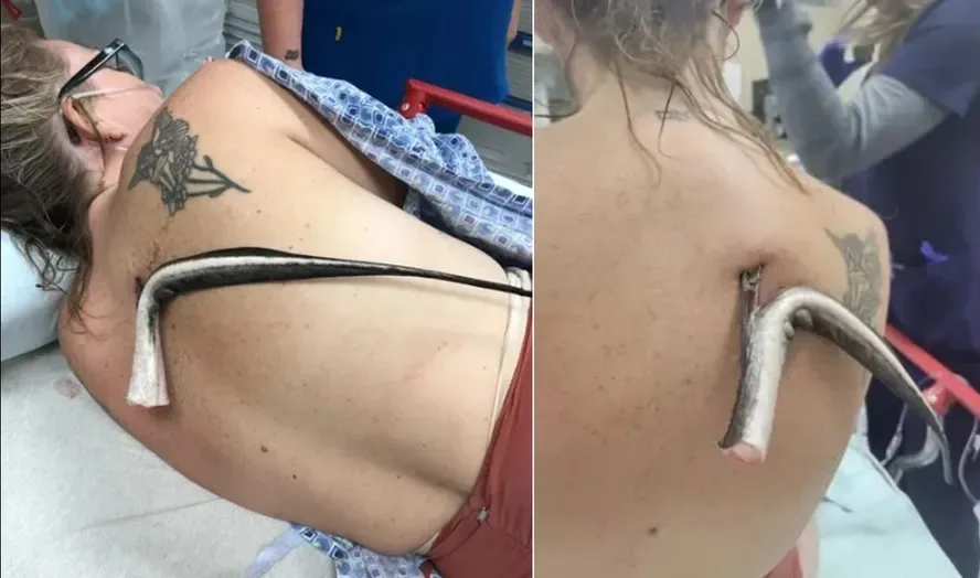 Ataque de arraia gigante em praia deixa mulher com ferrão no pulmão