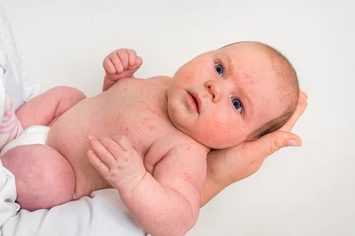 Saiba como evitar alergias em pele de bebê