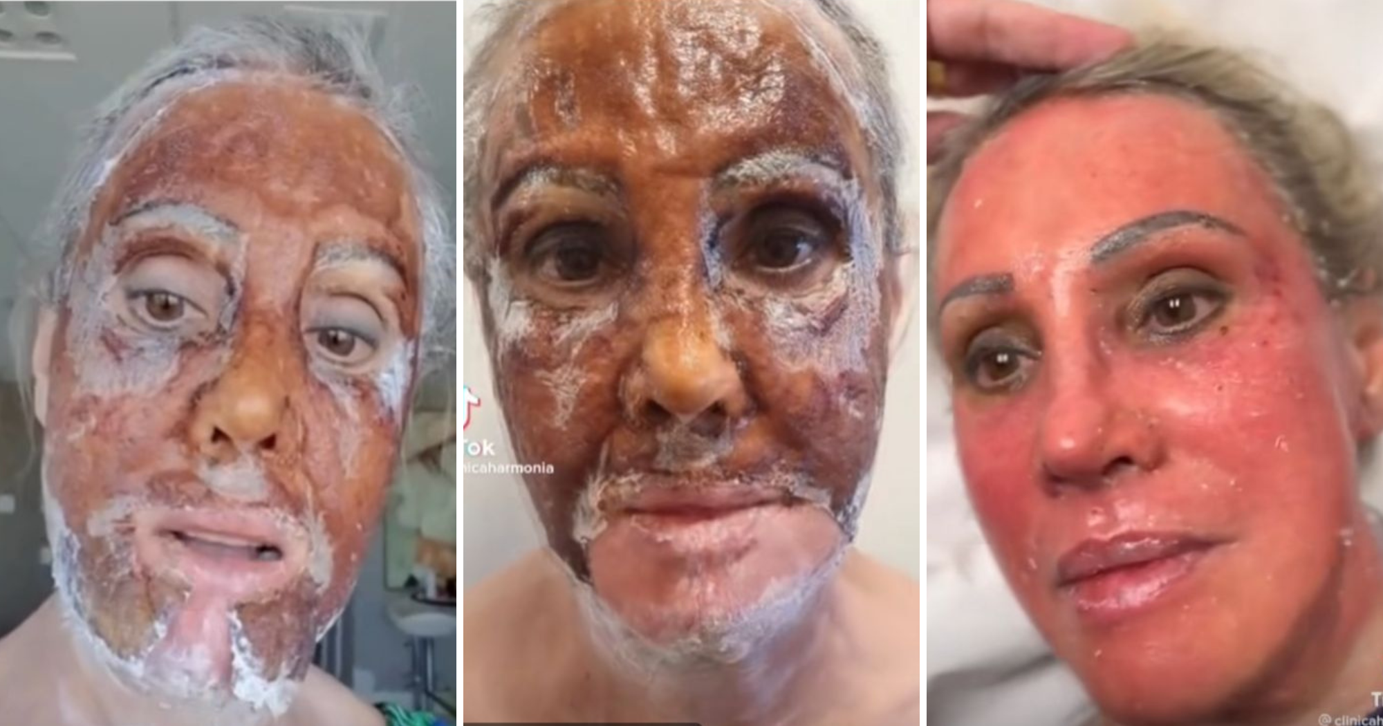 Vídeo: peeling de fenol viraliza e antes e depois choca. Entenda procedimento!