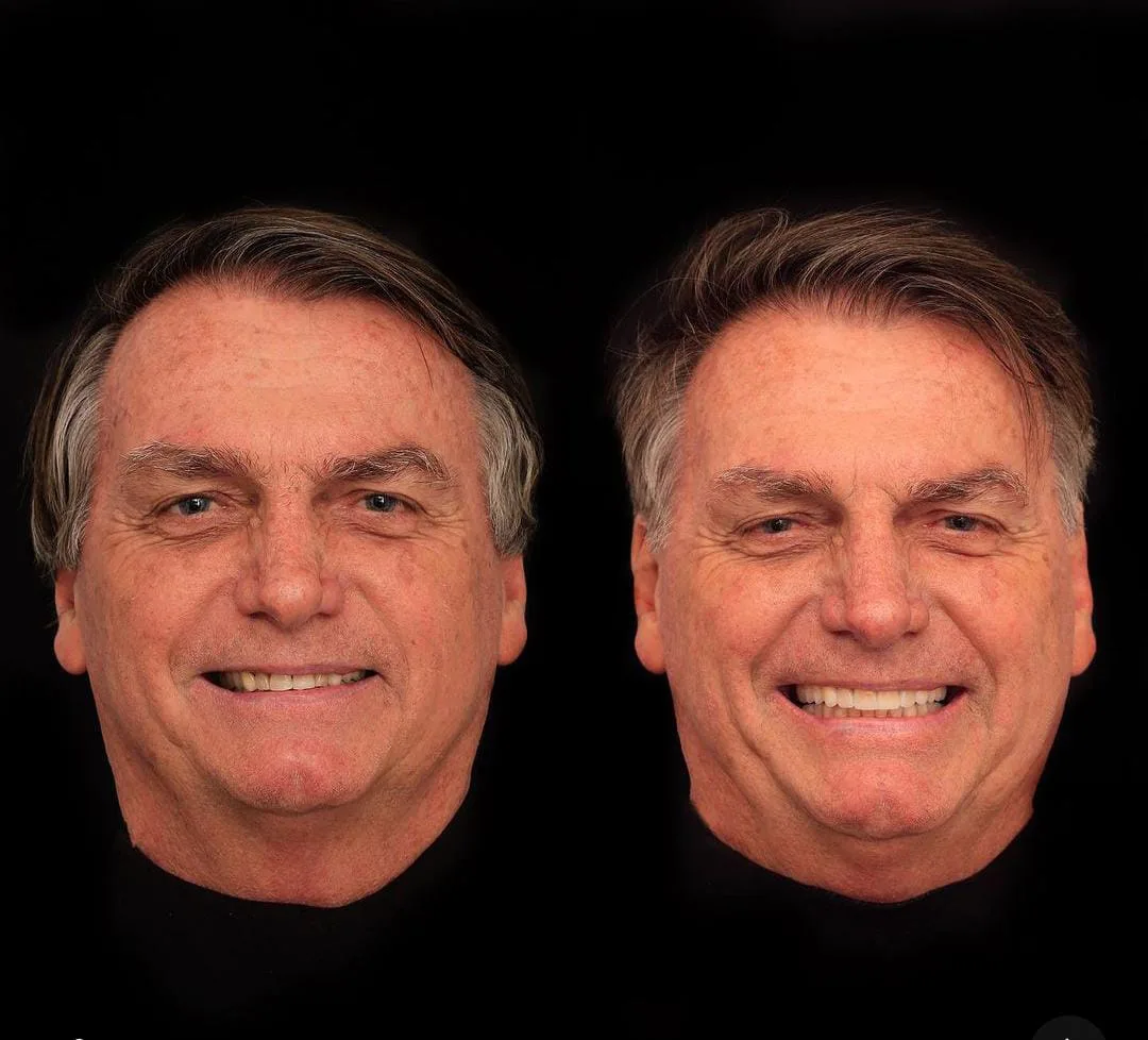 Bolsonaro fez harmonização dentária em meio à investigação da PF sobre joias