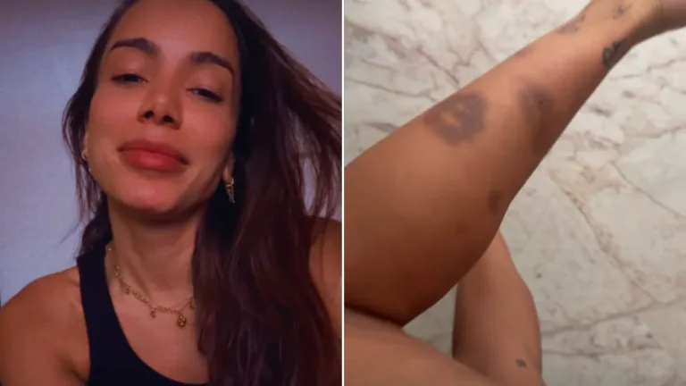 Anitta mostra hematomas após tentar resgatar cachorro perdido