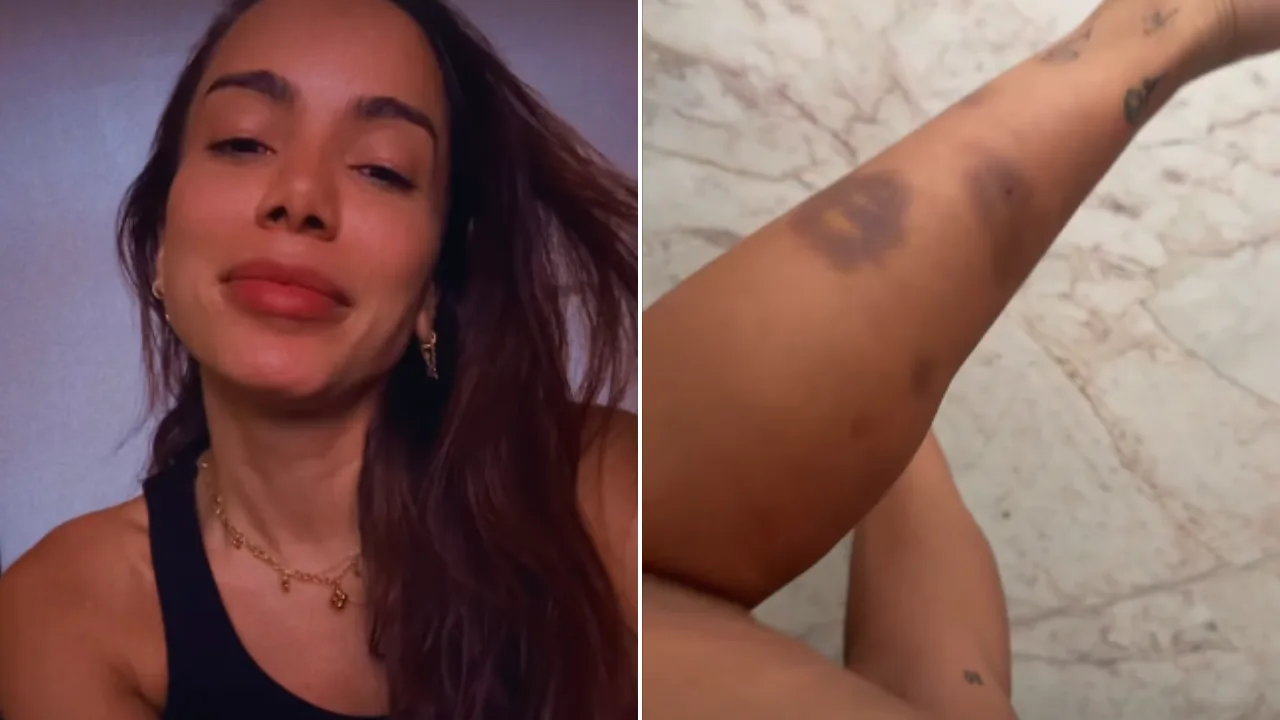 Anitta mostra hematomas após tentar resgatar cachorro perdido