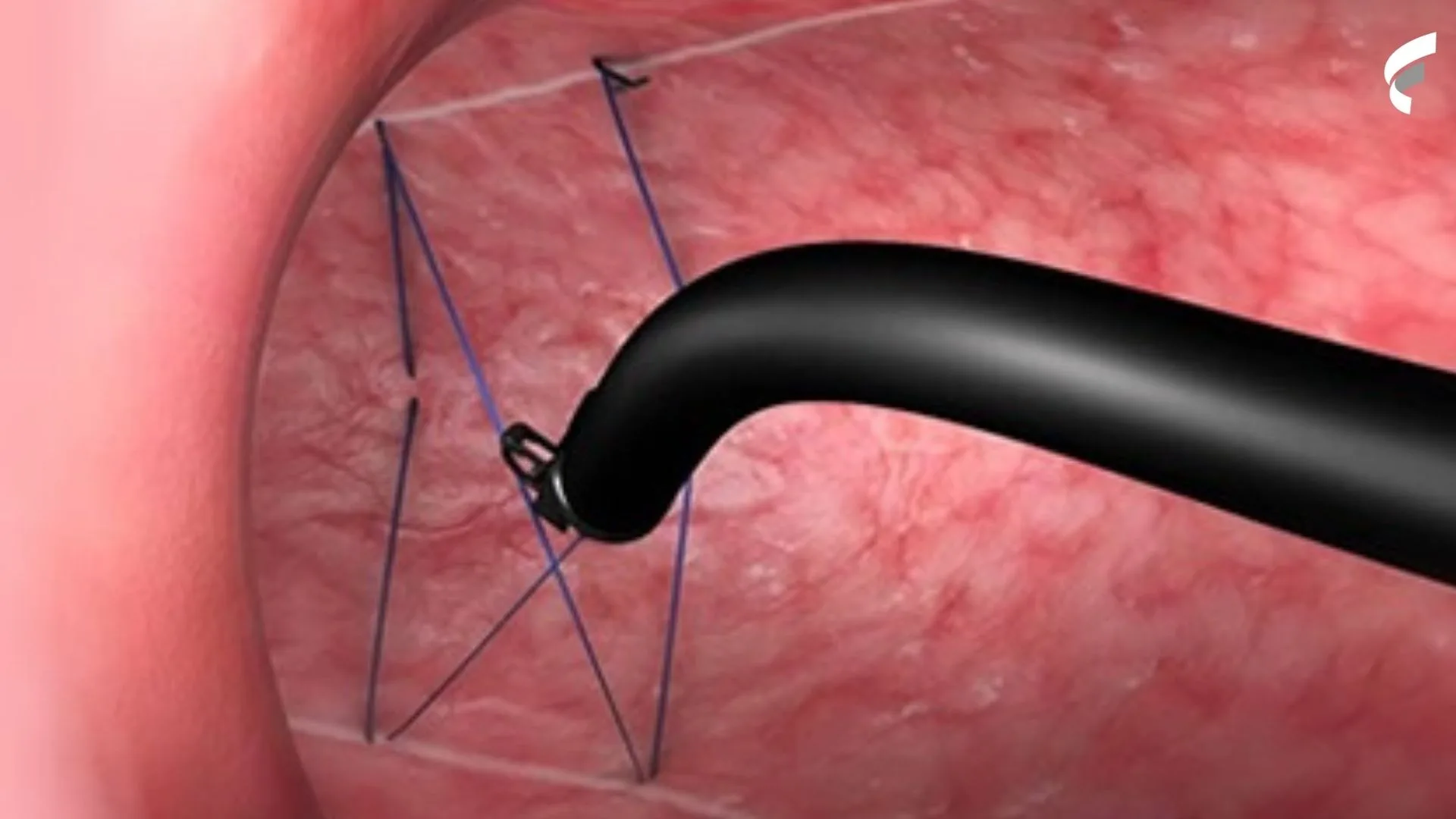 Como funciona a cirurgia para emagrecer por endoscopia? Veja preço e quem pode fazer