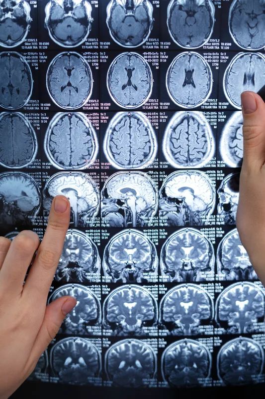 Neurocirurgião esclarece dúvidas sobre tumor cerebral 