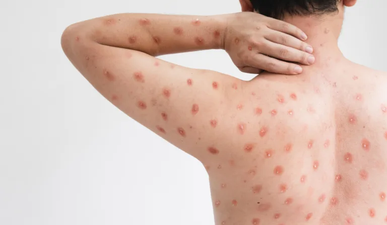 Doença mpox