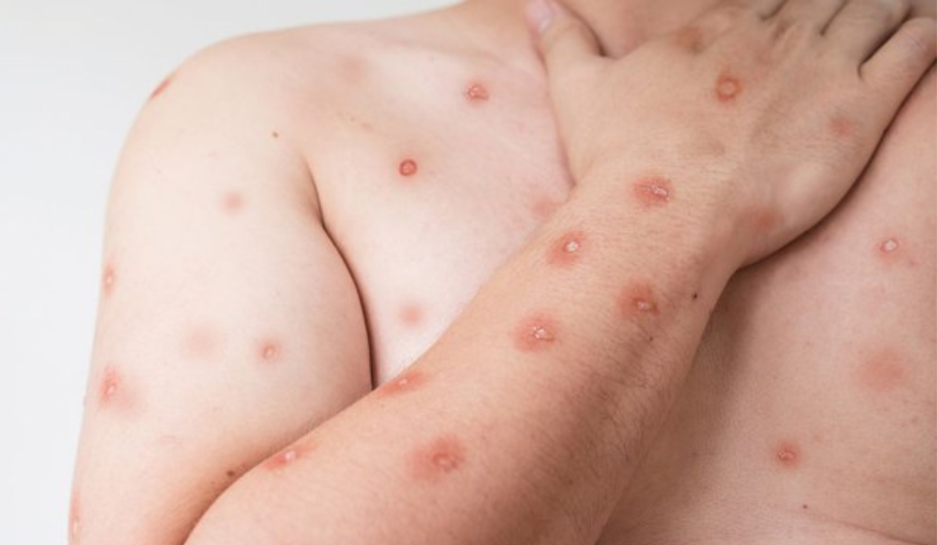 Doença mpox