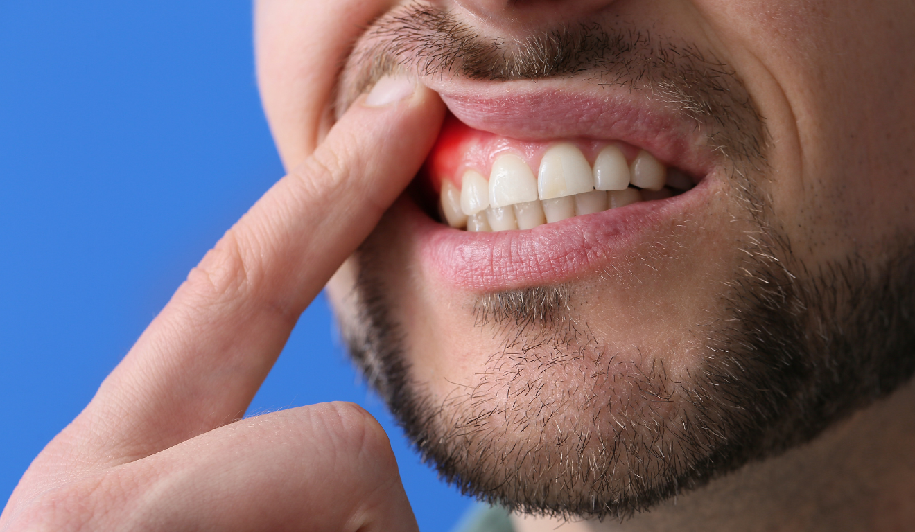 Homem mostra dentes e gengiva