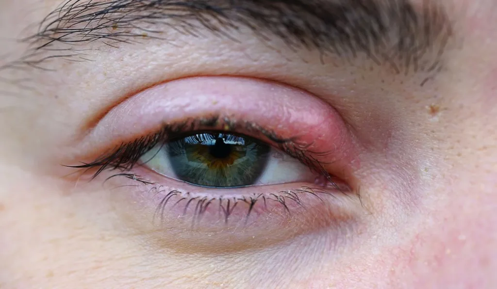 terçol infecção ocular hordéolo