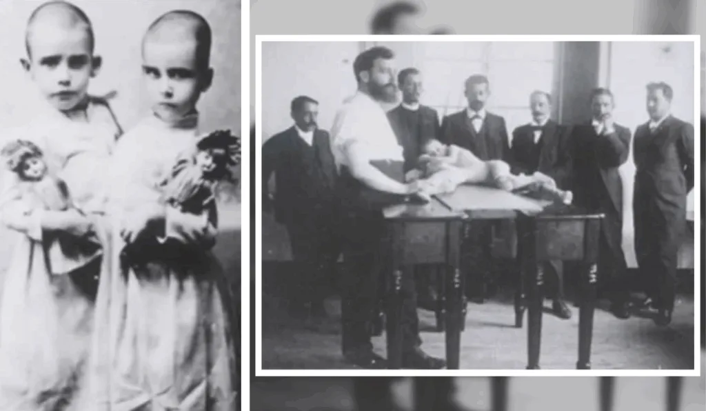 Rosalina e Maria Pinheiro Dável, gêmeas siamesas, e o médico Eduardo Chapot-Prévost e equipe