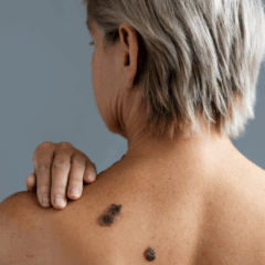 Melanoma