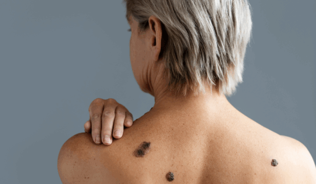 Melanoma