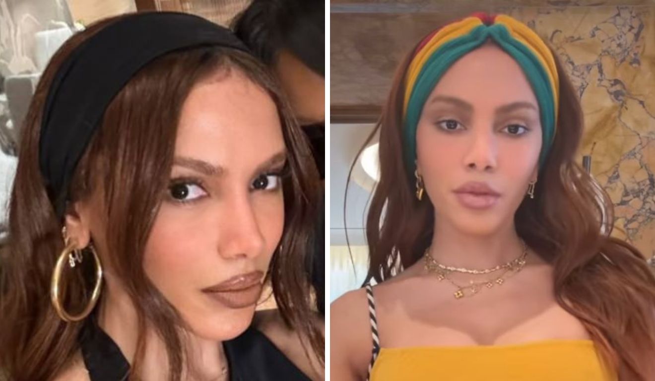 Anitta após procedimento estético Anitta após procedimento estético