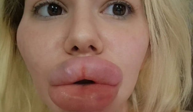 Andrea Rimanova preenchimento labial