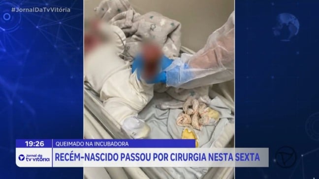 Bebê que teve pé queimado em incubadora passa por cirurgia