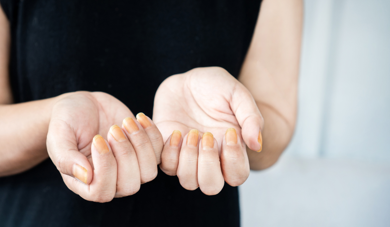Doença de unhas/Foto Canva