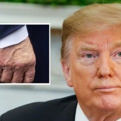 Donald Trump e mancha na mão