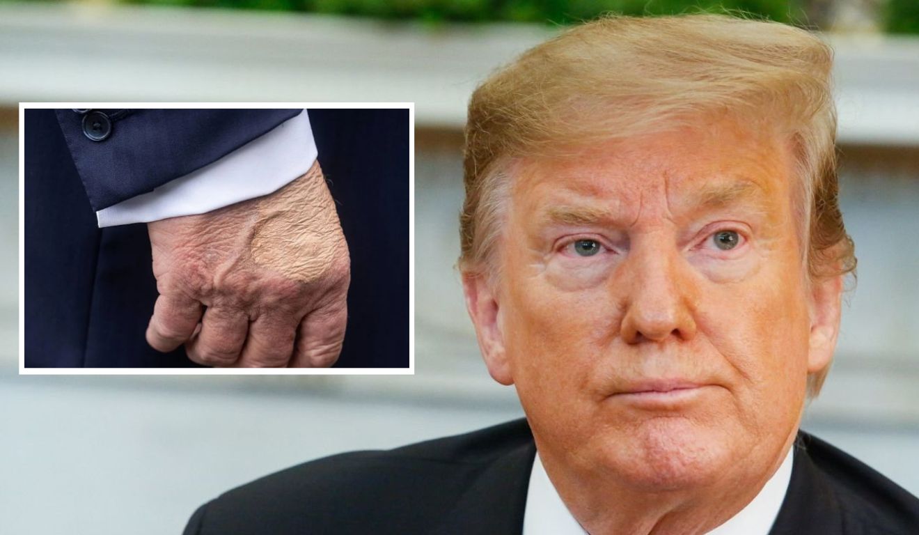 Donald Trump e mancha na mão