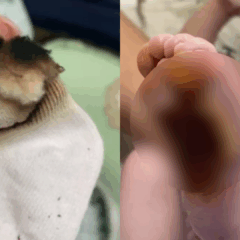 Bebê teve pé queimado em hospital (Foto/reprodução: redes sociais)