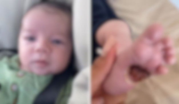 José, bebê que teve o pé queimado na Serra