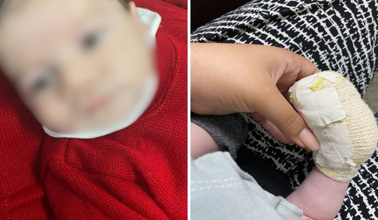 bebê pé queimado