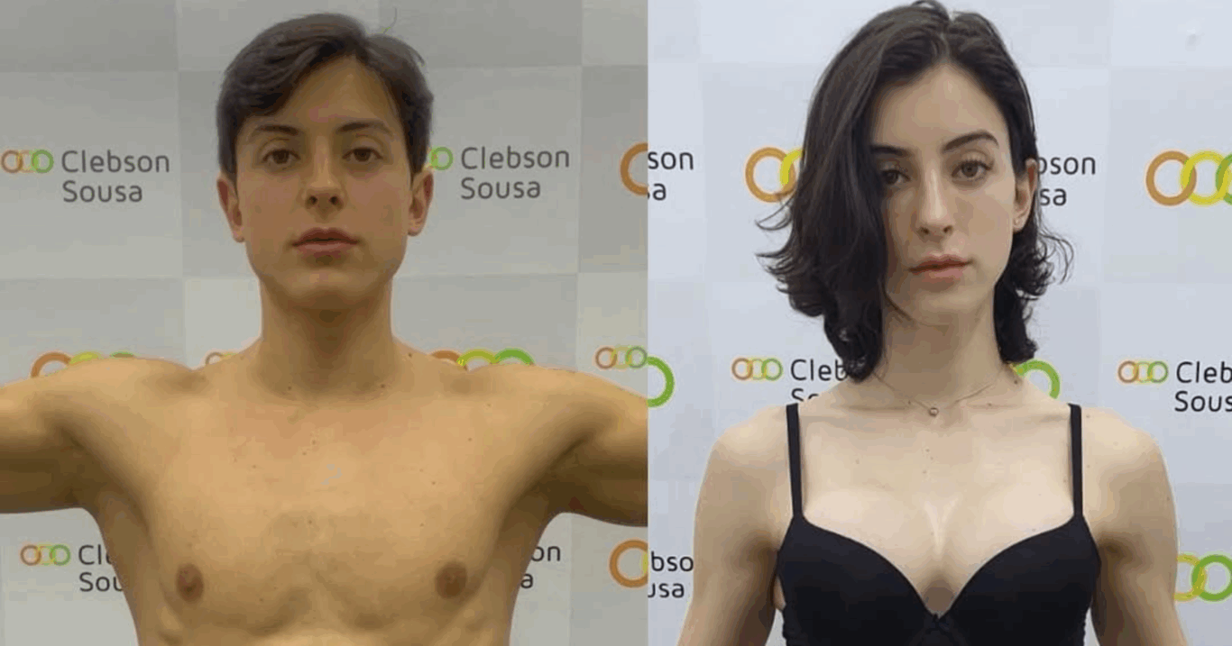 Bella Longuinho em seu antes e depois (Foto:Reprodução/Instagram @bella_longuinho)