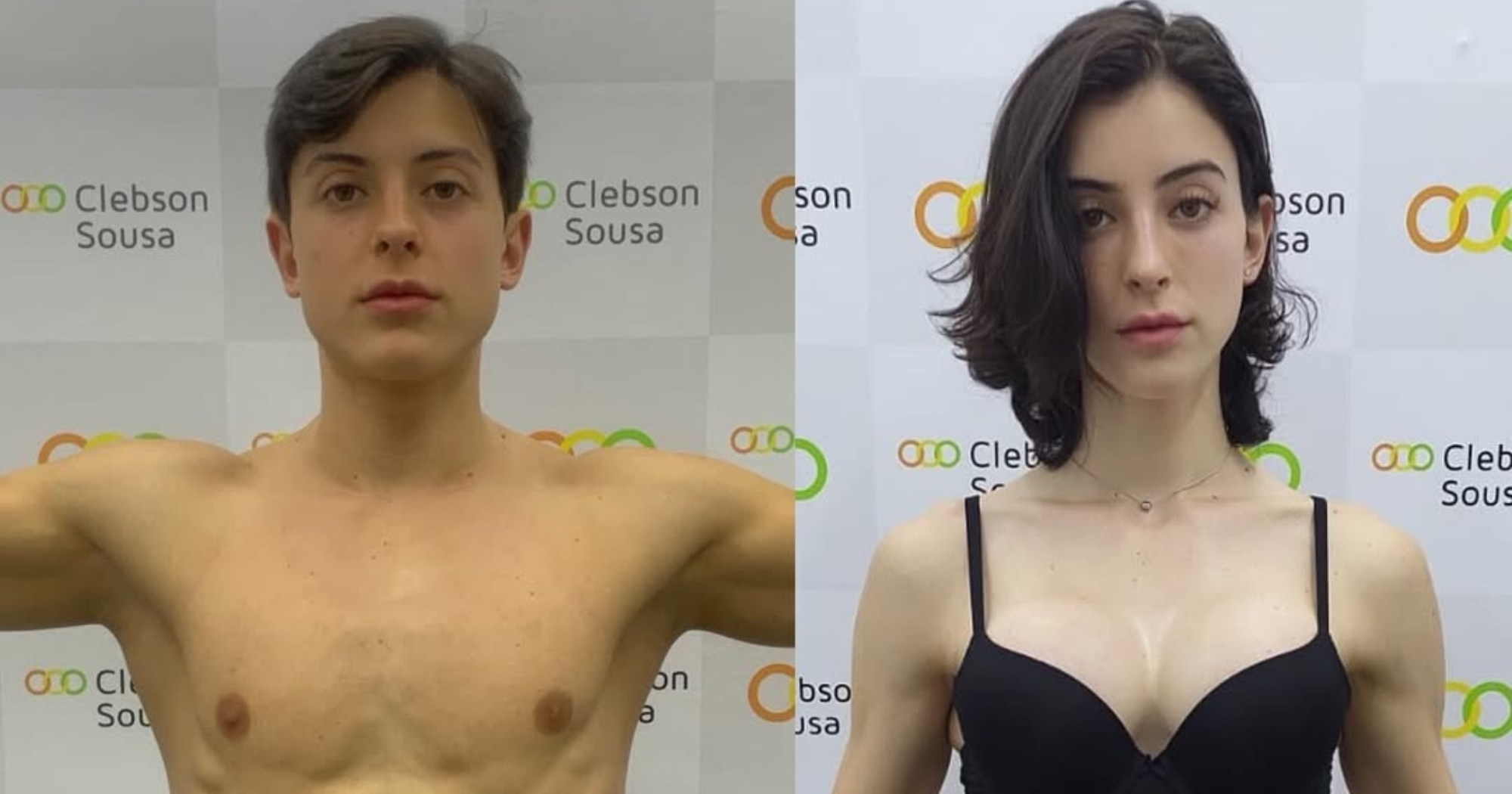 Bella Longuinho em seu antes e depois (Foto:Reprodução/Instagram @bella_longuinho)