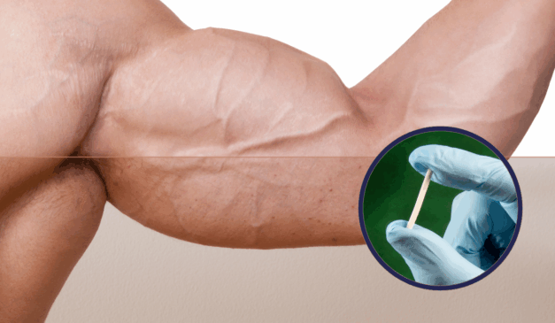 Apesar de popular, o uso de chip de testosterona pode ter efeitos colaterais graves e comprometer seriamente a saúde, sendo uma 'bomba' para o corpo/Canva