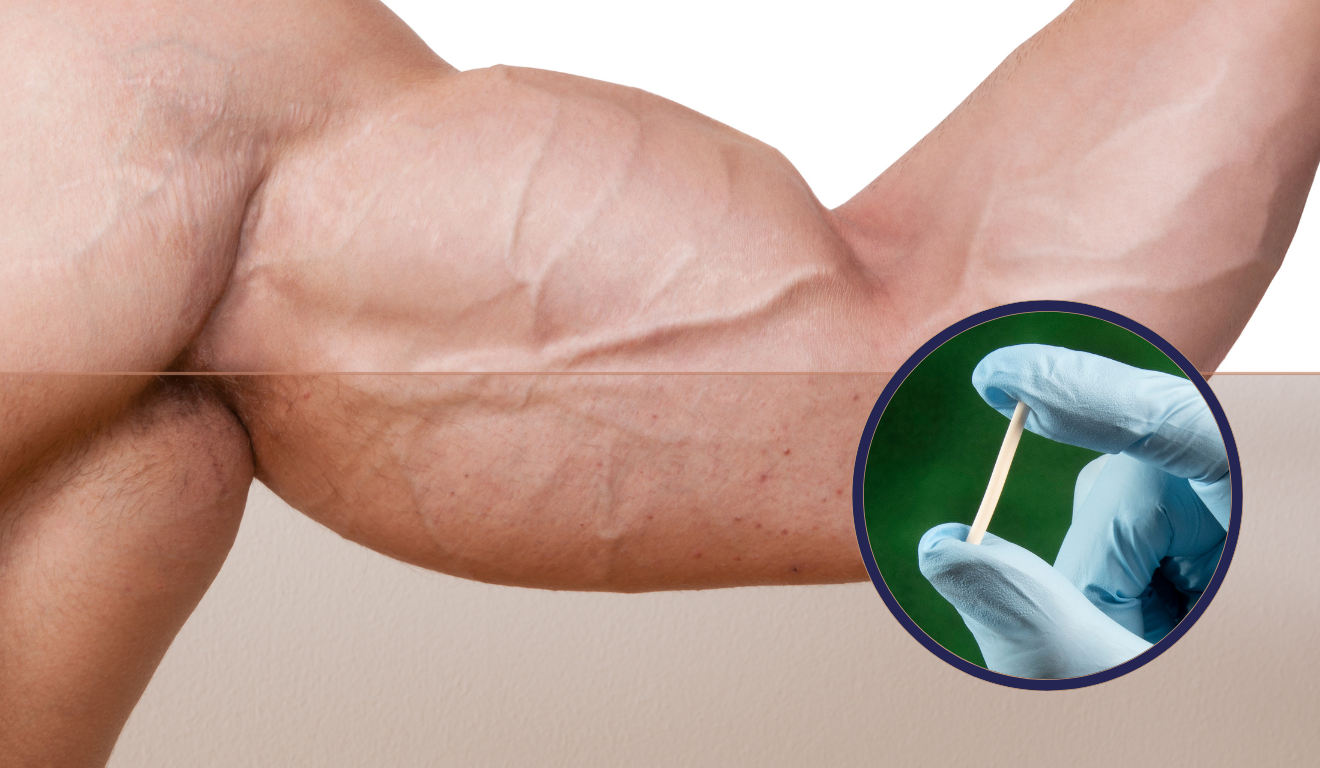 Apesar de popular, o uso de chip de testosterona pode ter efeitos colaterais graves e comprometer seriamente a saúde, sendo uma 'bomba' para o corpo/Canva Apesar de popular, o uso de chip de testosterona pode ter efeitos colaterais graves e comprometer seriamente a saúde, sendo uma 'bomba' para o corpo/Canva