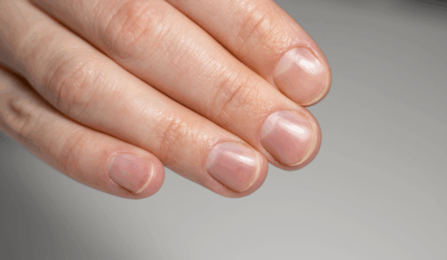 A cor das unhas pode refletir o estado de saúde do organismo; alterações persistentes devem ser investigadas/Canva