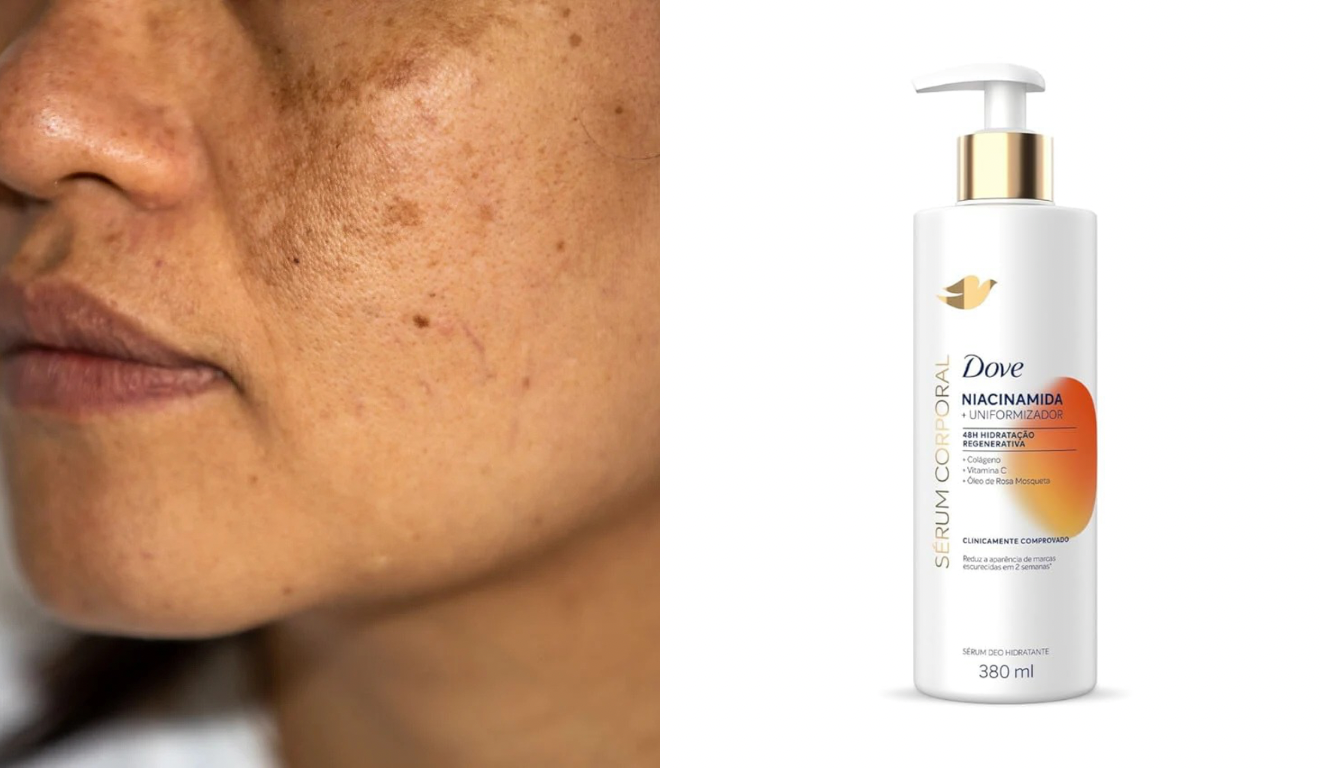 Produto da Dove com niacinamida acaba com as manchas do corpo e pele