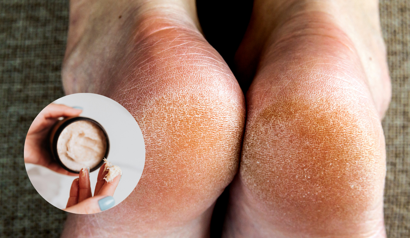 Com essa receita caseira de 3 ingredientes, você pode manter os pés sempre hidratados e livres de rachaduras, garantindo uma pele macia e saudável