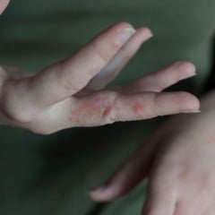 ESTUDANTES COM SARNA EM ESCOLA DE SÃO MATEUS