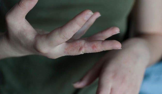 ESTUDANTES COM SARNA EM ESCOLA DE SÃO MATEUS