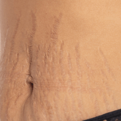 Dicas para disfarçar as estrias/Canva