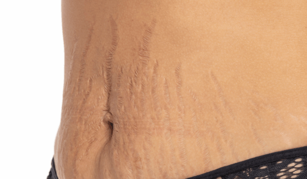 Dicas para disfarçar as estrias/Canva