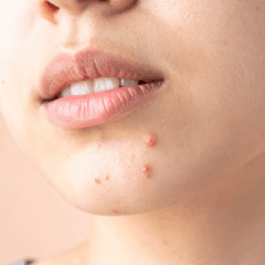 Aprenda como fazer uma limpeza de pele completa em casa e diga adeus aos cravos, espinhas e poros dilatados com estas 7 dicas essenciais/Canva