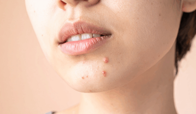 Aprenda como fazer uma limpeza de pele completa em casa e diga adeus aos cravos, espinhas e poros dilatados com estas 7 dicas essenciais/Canva