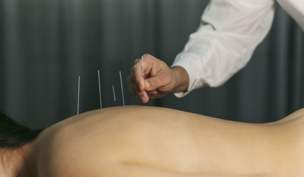 Acupuntura