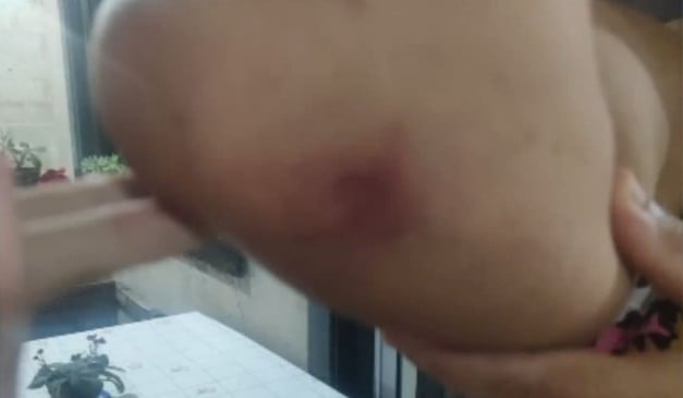 Vítima mostra o braço machucado. Foto: Reprodução/TV Vitória